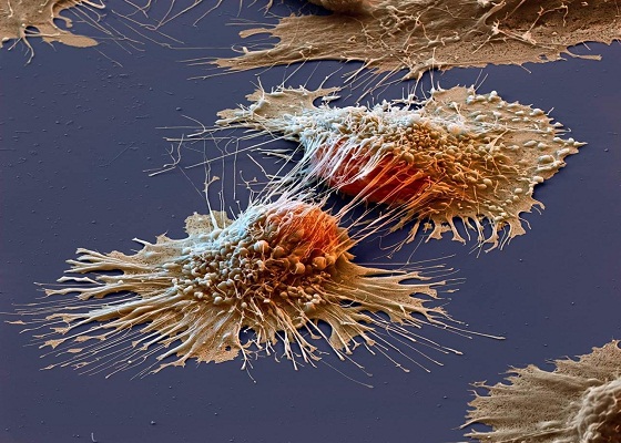 cancer cells under microscope e1506203333845