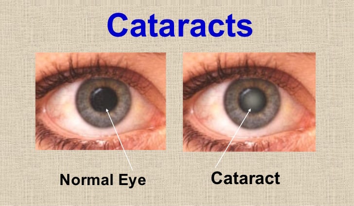 cataract.jpg