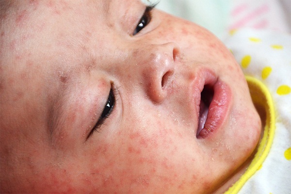 measles rash closeup